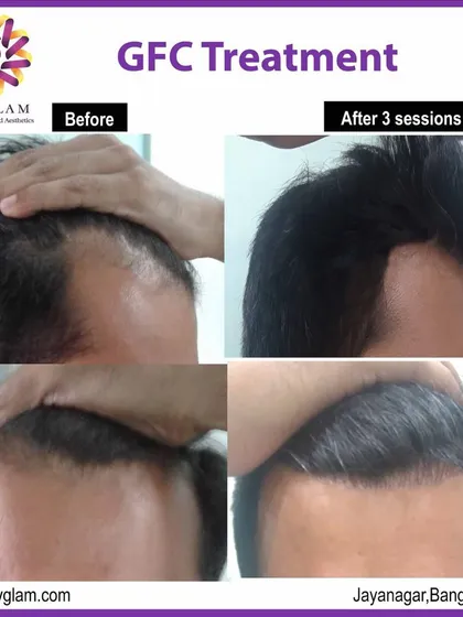 This client's hairline was restored after just three sessions of our non-surgical GFC treatment. Notice the significant increase in hair density and the natural-looking frontal coverage.