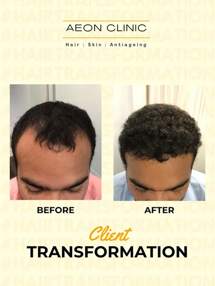 A clear look at a client's transformation. Our focus is always on creating dense, natural-looking results that blend seamlessly with your existing hair.