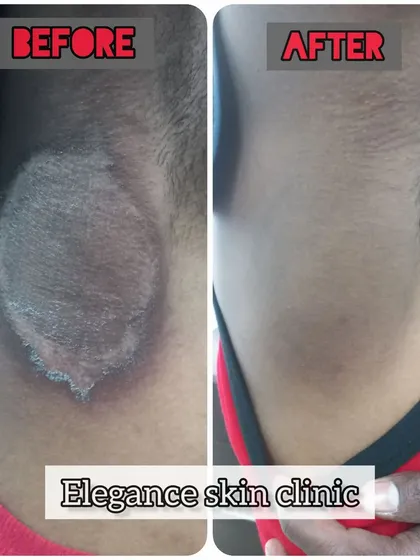 This before and after image shows the successful treatment of Tinea, a common fungal infection. Complete resolution requires patience and finishing the full course of treatment prescribed by a dermatologist, and it is crucial to avoid steroid creams which can worsen the condition.