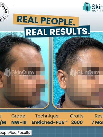 A side-profile view of the 24-year-old patient with Norwood Grade III hair loss. The 7-month result after 2600 grafts shows a well-defined and natural-looking hairline.