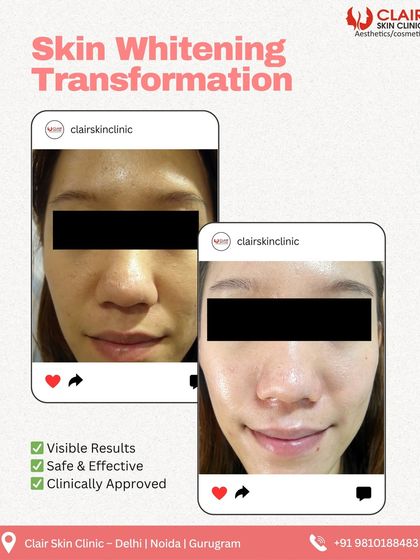 A skin whitening transformation that highlights a brighter, more luminous complexion. Our clinically approved treatments are safe, effective, and deliver visible results you can trust.