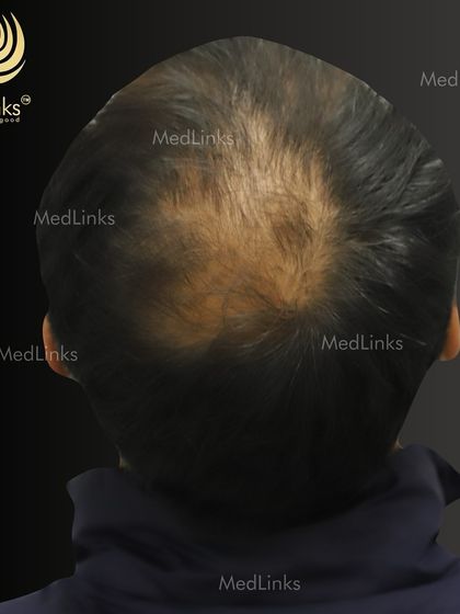 The view from the back, showing the thinning crown area that we are about to restore. Our techniques are designed to create density that looks completely natural from all angles.