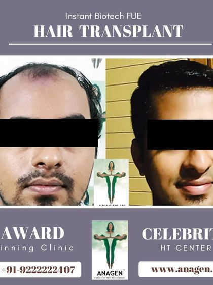 An excellent result from our Instant Biotech FUE hair transplant. The before and after photos speak for themselves, showing a complete transformation.