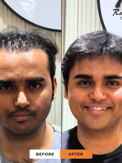 This is the before-and-after of the patient from video 41. The 'after' photo shows a happy, smiling patient with a full, dense head of hair, a complete transformation from his previous state.