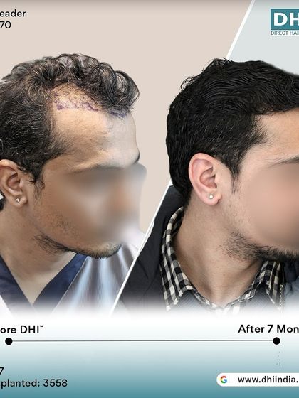 A side-profile view of the same client's 7-month progress. The restored hairline and increased thickness are clearly visible, showcasing a natural and youthful result.