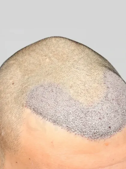 Precision in every graft. A close-up of a 2200 graft placement for a Grade 2 baldness case, focusing on a natural and dense hairline.