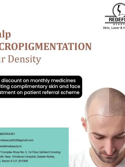 An informational post about Scalp Micropigmentation, a procedure we offer to improve the appearance of hair density. It's an effective way to create the look of a fuller head of hair without surgery.