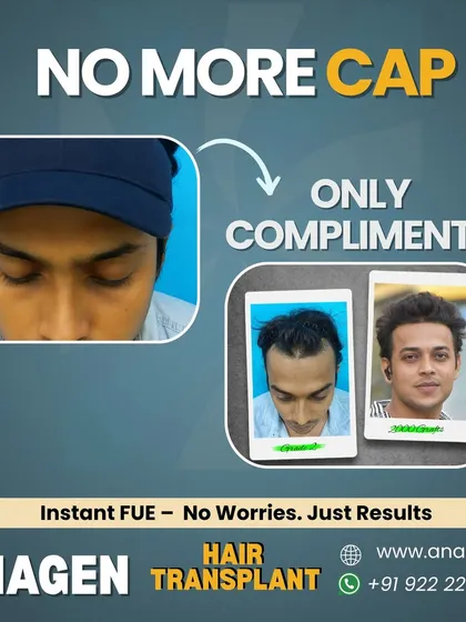Another patient who can now enjoy compliments instead of wearing a cap. Our Instant FUE technique provides results you can be proud of, restoring a natural and full hairline.