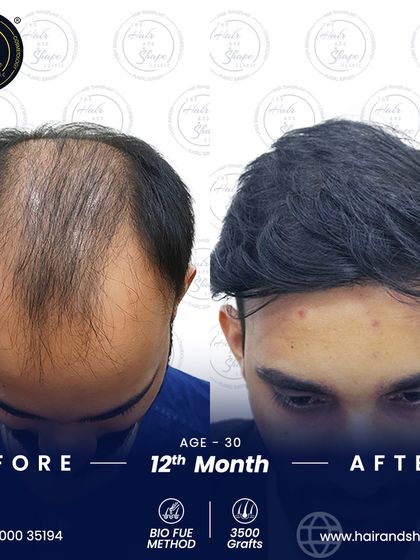 A top-down view showing the incredible density achieved 12 months after a BIO FUE hair transplant. We successfully covered the balding area for a complete look.