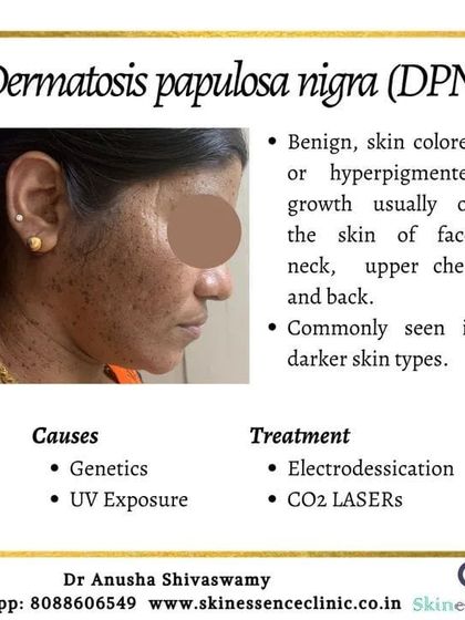 Anusha Shivaswamy - Minor Skin Surgery (Dermatosurgery) Safe Removal of Skin Tags & DPNs photo 4