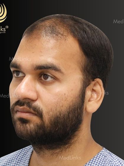 The patient's hair from the side before the procedure.