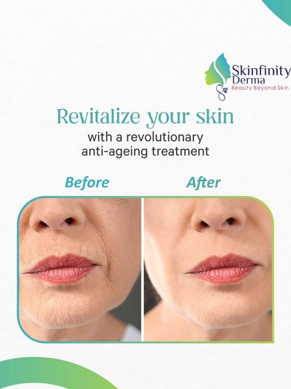 Revitalize your skin with Profhilo. This before-and-after image shows the remarkable reduction in fine lines and wrinkles around the mouth, demonstrating the treatment's power to restore a smoother, more youthful look.