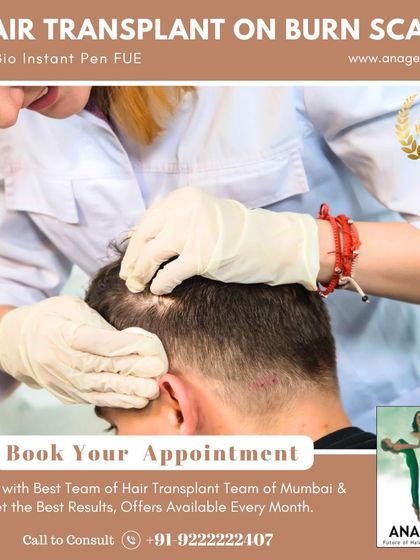 This image highlights our ability to perform hair transplants on burn scars. We use the Bio Instant Pen FUE method to carefully place grafts in the affected area, achieving excellent results.