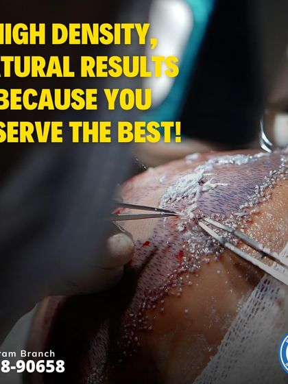 Another view of the implantation phase. Achieving high density requires placing grafts close together without damaging them, a skill that comes with experience and the right tools.