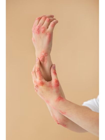 Autoimmune skin diseases like psoriasis or lupus require expert diagnosis and a carefully managed treatment plan. My approach focuses on controlling symptoms, reducing flare-ups, and improving your overall quality of life through medical therapies.