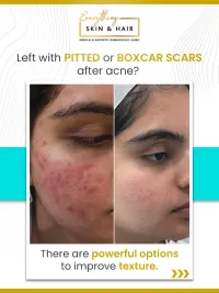 Acne and Scar Treatment