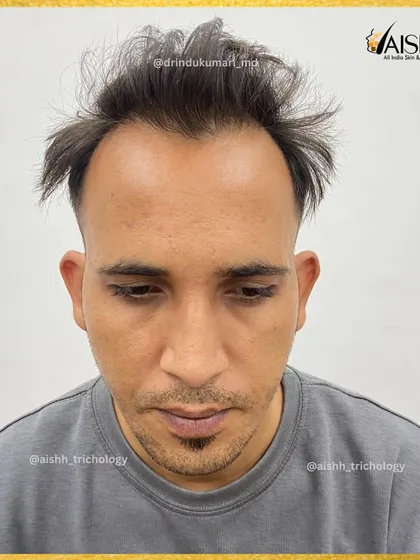A frontal 'before' shot of the same patient, clearly showing the receding hairline and thinning at the top.