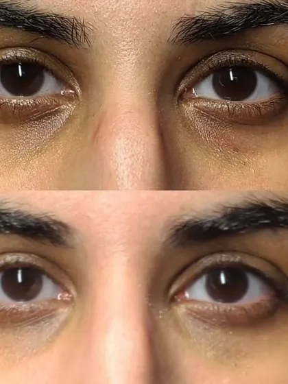 A clear example of how my under-eye treatment works in just one session. This before-and-after shows a significant reduction in dark circles and hollows, making the eyes look instantly brighter and more rested.