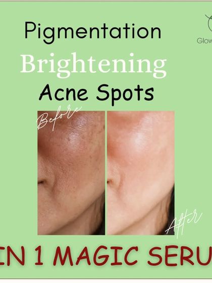 My 3-in-1 Magic Serum is perfect for pigmentation, brightening, and acne spots. The before and after results speak for themselves.