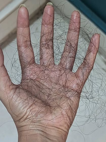 To provide a different perspective, here are 100 strands of shed hair spread across my hand. Understanding this baseline can help reduce anxiety about normal shedding and signal when to seek professional help.