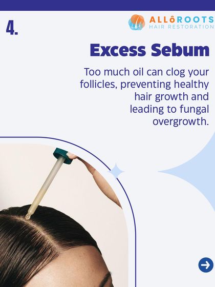 Your scalp naturally produces oil, or sebum, but too much of it can clog your follicles. This not only prevents healthy hair growth but can also lead to fungal overgrowth.