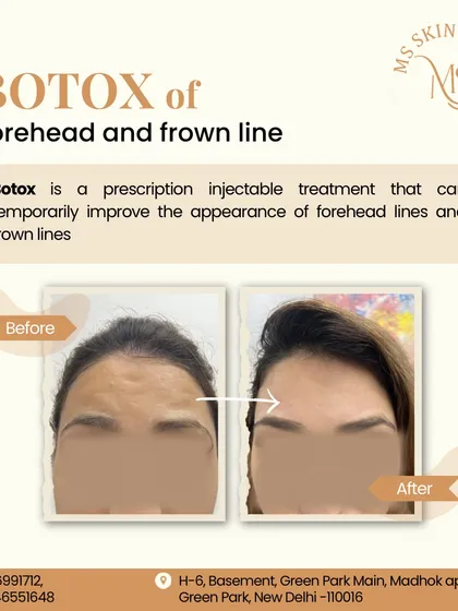 This is a powerful example of how I use Botox to smooth deep-set forehead and frown lines. The goal is always a natural, refreshed appearance, not a "frozen" look. This simple procedure can take years off your appearance and prevent lines from becoming permanently etched into the skin.