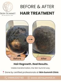 Hair Restoration Treatments