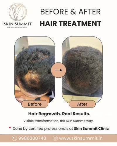 Hair Restoration Treatments