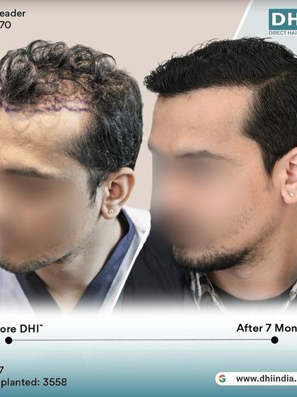Another side-profile view of the 7-month transformation. This angle highlights the seamless integration of the new hair, creating a natural and aesthetically pleasing outcome.