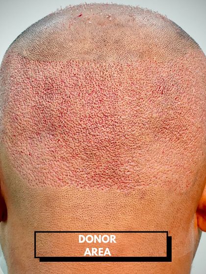 Skinmatics - Hair Restoration FUE Hair Transplant: Results & Transformations photo 12