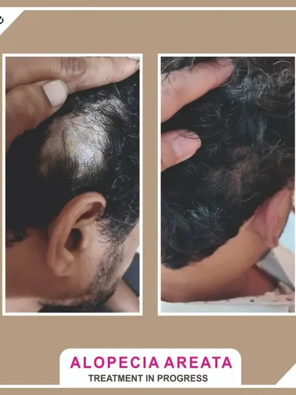I offer targeted treatments for specific conditions like Alopecia Areata. This client is in the process of treatment for a bald patch, and you can already see the incredible progress in hair regrowth.