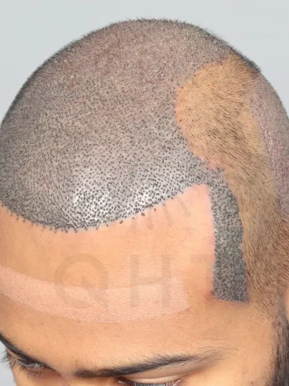 A Norwood Grade 6 transformation in progress. 5900 grafts were placed to recreate the hairline, frontal part, mid-scalp, crown, and temples.