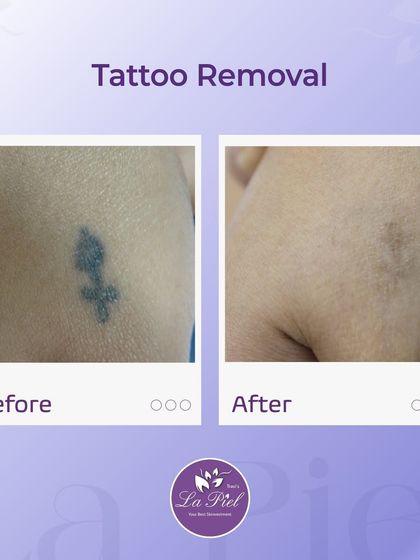 This before-and-after demonstrates the effectiveness of our advanced laser tattoo removal process. The treatment works by breaking down the ink particles over a series of sessions, allowing the body to clear them and gradually fade the tattoo, leaving the skin looking clearer.