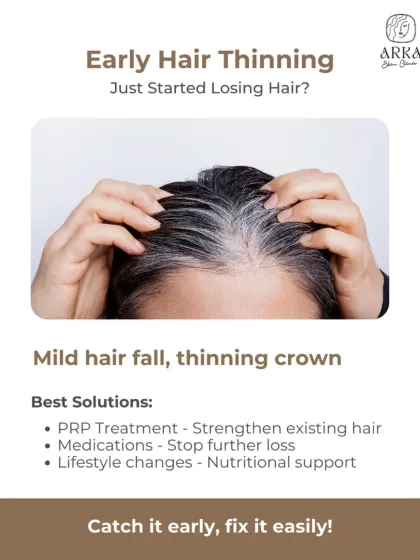 If you have just started noticing your hair thinning or a little more hair fall than usual, now is the best time to act. For early-stage hair loss, we have effective non-surgical solutions like PRP therapy and medications to strengthen existing hair and prevent further loss.