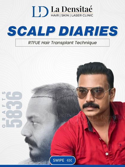 Actor Pramod Mani's case was challenging, but with the advanced RT-FUE technique and 5,836 grafts, we achieved a great result. His story proves that success depends on expertise, not luck.
