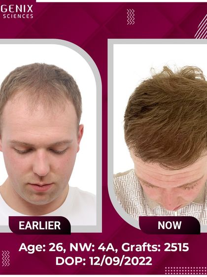 A complete before-and-after set of a 26-year-old patient from the UK, showcasing a restored hairline and youthful appearance.