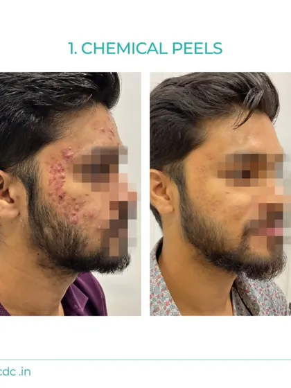 This before and after demonstrates the effectiveness of our customized chemical peel protocols for treating inflammatory acne. We create personalized plans to reduce breakouts and improve skin texture for long-term results.