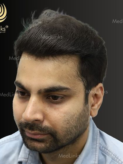 The final result from the side, showing a natural and dense hairline.