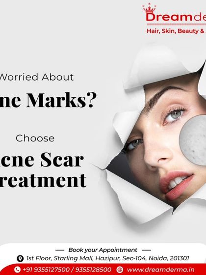 Worried about acne marks? This image encourages you to choose a targeted acne scar treatment to regain smooth, clear skin.