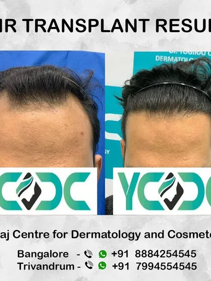 This before and after highlights the transformation of a receding hairline into a full and robust one, completely changing the patient's appearance.