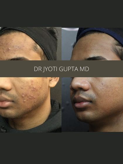 Another angle showing the successful reduction of acne on the cheeks and forehead. My treatment plans are comprehensive, targeting the root cause of acne for long-term results.