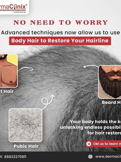 No need to worry if your scalp donor area is limited. We can use hair from the beard, chest, and other body areas to achieve full coverage, unlocking new possibilities for hair restoration.