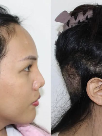 This view shows both the donor area (where hair was taken from the back) and the newly created recipient site at the front.