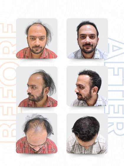 For Mr. Unmesh Thatte, precision made all the difference. I meticulously placed 4,186 grafts using the advanced RT-FUE technique. The result is seamless coverage from the front, side, and crown, marking a new chapter for him.