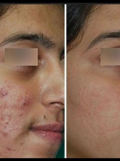 This image shows the significant progress made in treating both cystic acne and the resulting atrophic scars, leading to smoother and clearer skin.