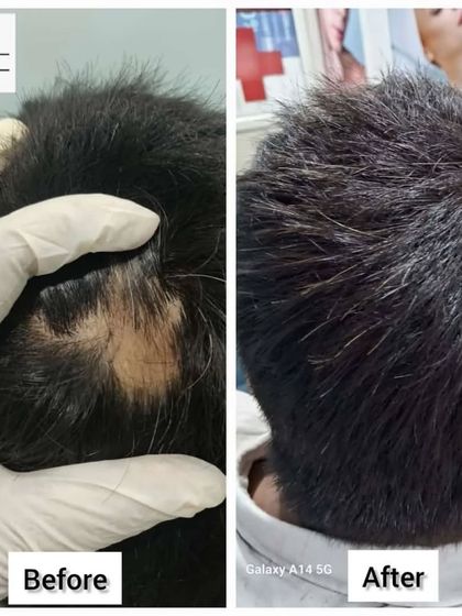 Another clear example of our success in treating alopecia areata. The bald patch is completely filled in with new hair after undergoing our personalized treatment protocol.