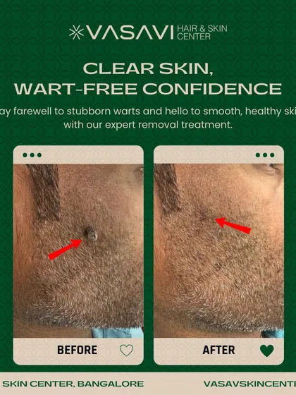 This demonstrates the precise removal of a facial wart from a patient's beard area. Treating facial growths requires careful technique to ensure complete removal and prevent scarring, which is my primary goal for all my patients.