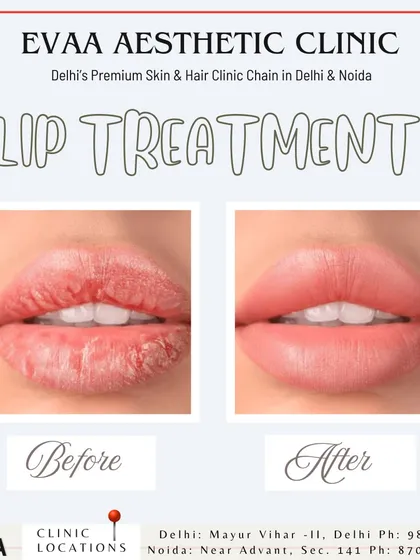 See the transformative power of our lip treatments. This before-and-after image displays how we can hydrate chapped lips and enhance their natural shape, resulting in a fuller, smoother, and more defined look.
