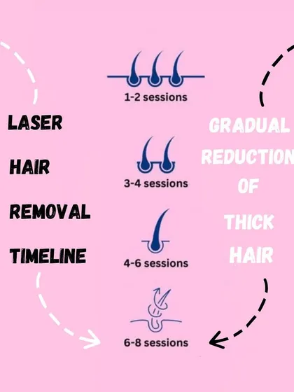 Laser hair reduction is a journey, not a one-time fix. This timeline shows you what to expect, from the gradual reduction of thick hair in the first few sessions to achieving up to 80% permanent reduction after a full course of 6 to 8 sessions.