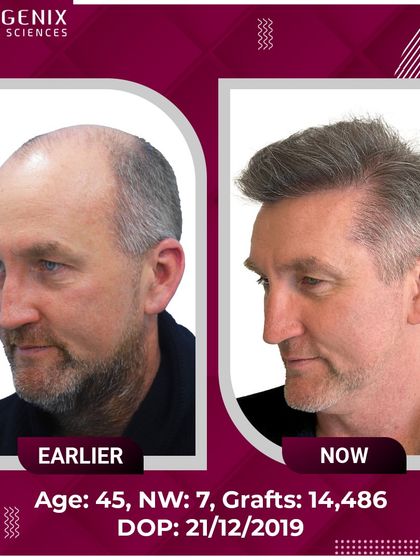 An incredible transformation of a 45-year-old international patient with Grade 7 baldness, who received 14,486 grafts for a full head of hair.